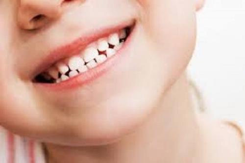 قطره آهن دندان را سیاه می کند گول نخورید