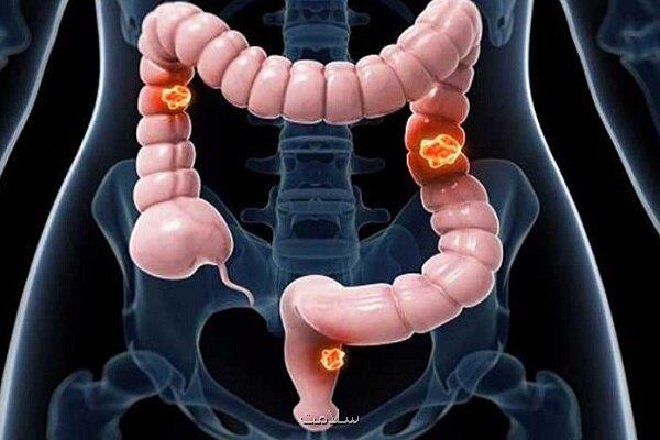 پیش بینی اولیه خطر مبتلاشدن به سرطان روده